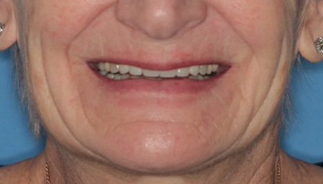 Close up of mouth with evenly spaced front teeth