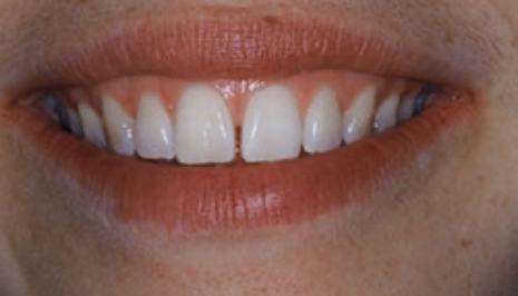 Close up of smile with imperfect teeth