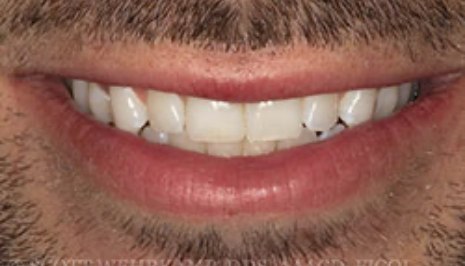 Close up of smile with flawless teeth