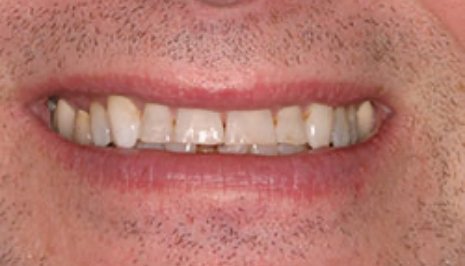 Close up of smile with imperfect teeth