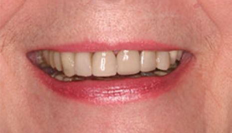 Close up of smile with imperfect teeth