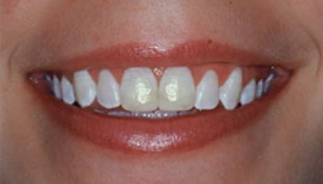 Close up of smile with imperfect teeth