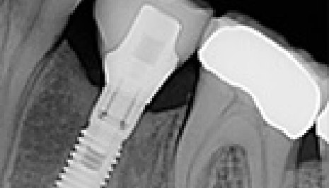 Jaw X ray of a dental implant patient