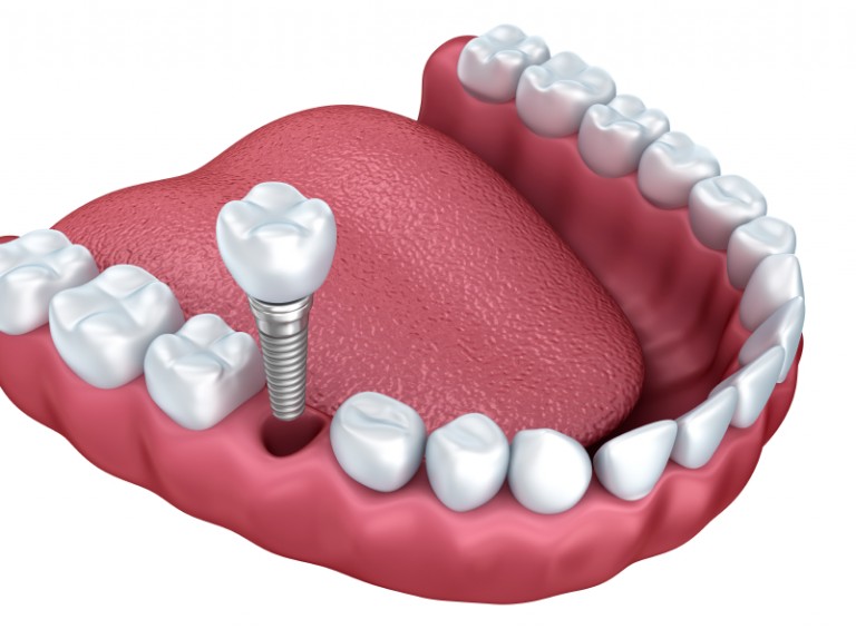 Your dentist for dental implants in Brandon.