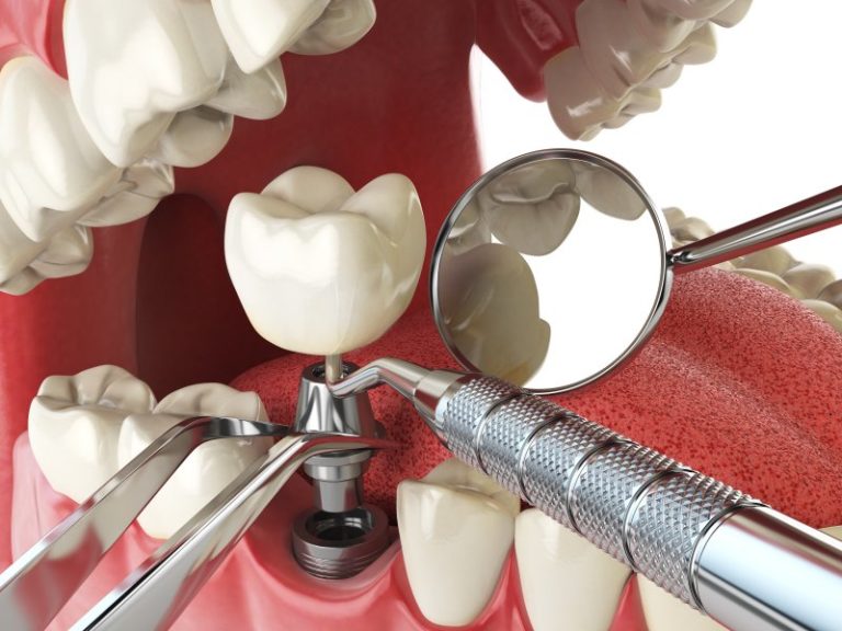 different parts of dental implant