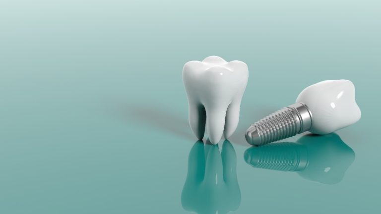 dental implant and molar