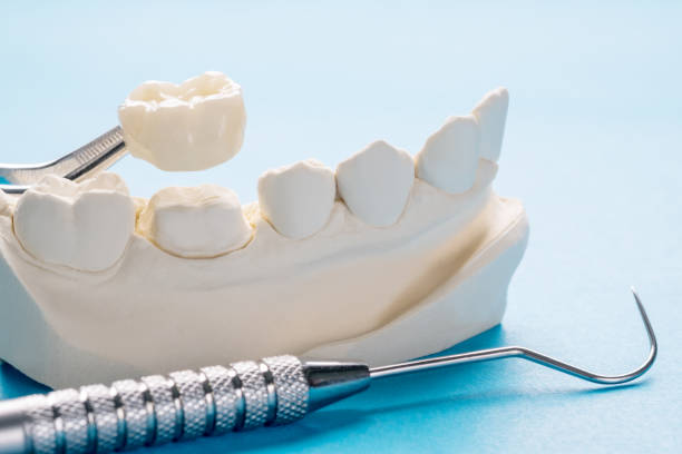 Model of dental crown and dentist’s probe